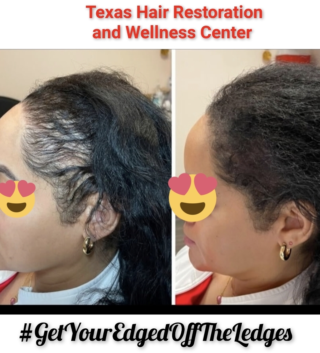 Approved Texas Hair Restoration & Wellness Center client photograph shared with permission